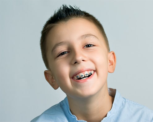 Early Orthodontic Treatment for Kids | Apple Dental Care