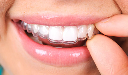 Invisalign, Edmonton Dentist